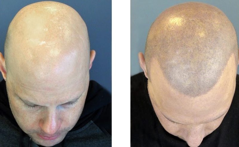How Scalp Micropigmentation Works and Why It Is Important